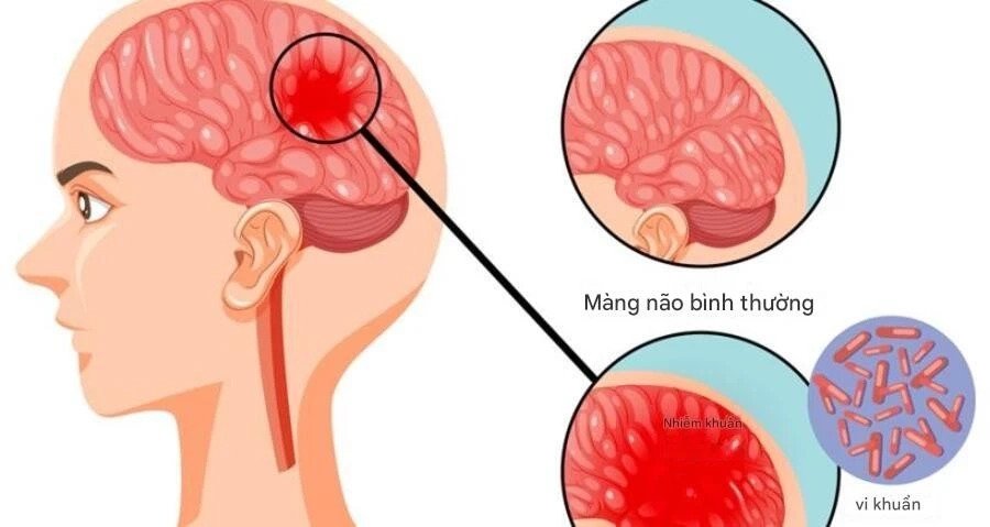 TPHCM Ghi Nhận Ca Não Mô Cầu Mới, Trẻ Đã Tiêm Vaccine Vẫn Mắc Bệnh